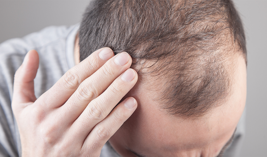  RU58841 vs Finasteride for hair loss
