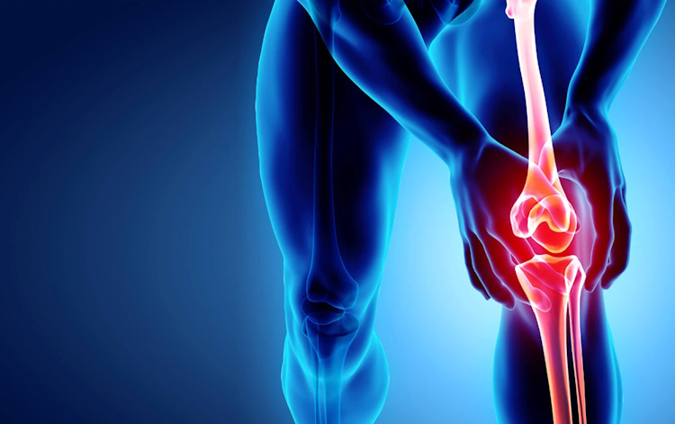 Sodium hyaluronate: a naturally occurring option for joint pain