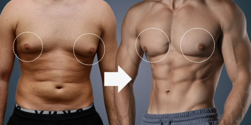 Gynecomastia in bodybuilding: causes, mechanisms, and treatment options