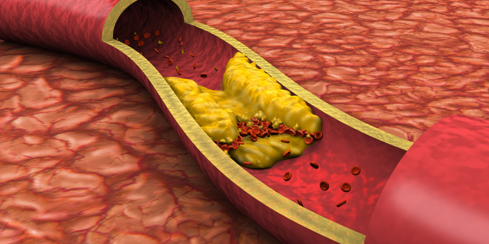 Cholesterol Medications in Bodybuilding